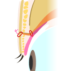 極細の糸で丁寧に縫合します