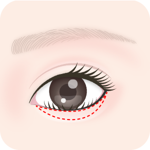 余分な皮膚を切り取る切開デザイン