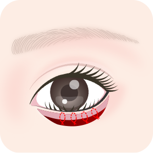 中縫い法では瞼板と眼輪筋を縫合します