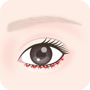 極細の糸で皮膚を縫合します